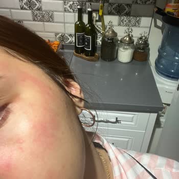 Yves Rocher Nemlendirici Yüzümde Yanma Ve Kızarıklık Yaptı