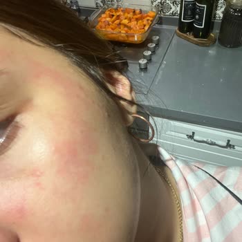 Yves Rocher Nemlendirici Yüzümde Yanma Ve Kızarıklık Yaptı