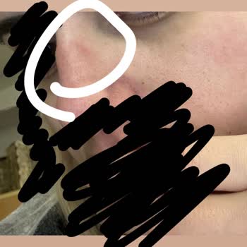 Ağır Gözlükler Burnumda Ağrıya Sebep Oldu