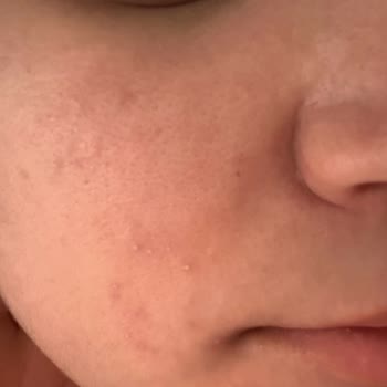 Origins Ginzing SPF 40 Moisturizer Caused Breakouts and Skin Irritation