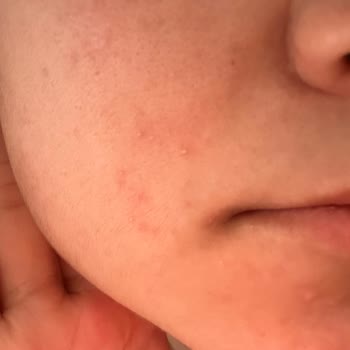 Origins Ginzing SPF 40 Moisturizer Caused Breakouts and Skin Irritation