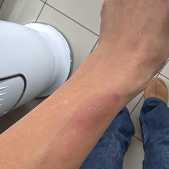 Yanlış Lazer Uygulaması Ve Yanıklar