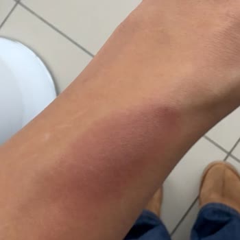 Yanlış Lazer Uygulaması Ve Yanıklar