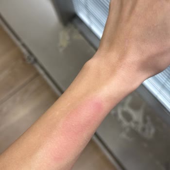 Yanlış Lazer Uygulaması Ve Yanıklar