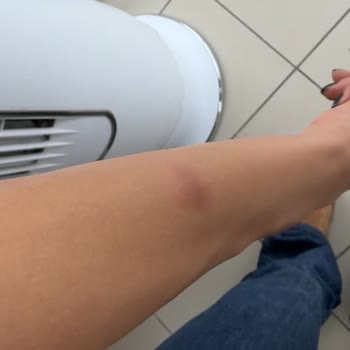 Yanlış Lazer Uygulaması Ve Yanıklar