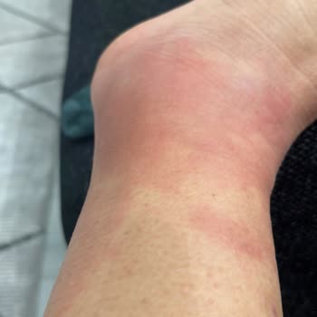 Yanlış Tedavi Nedeniyle İyileşemeyen Ayak Sorunu