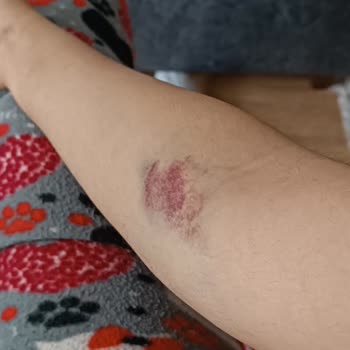 Türk Kızılay Kan Bağışı Sonrası Yaşanan Ağrı Ve Morarma Sorunu