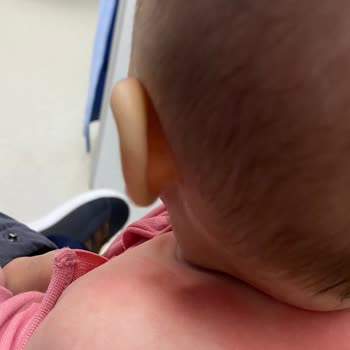 Milupa Aptamil Mama Kullanımı Sonrası Ciddi Alerjik Reaksiyon