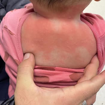 Milupa Aptamil Mama Kullanımı Sonrası Ciddi Alerjik Reaksiyon