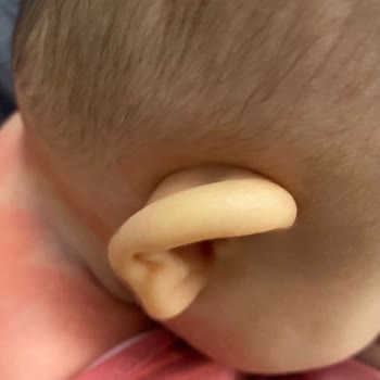 Milupa Aptamil Mama Kullanımı Sonrası Ciddi Alerjik Reaksiyon
