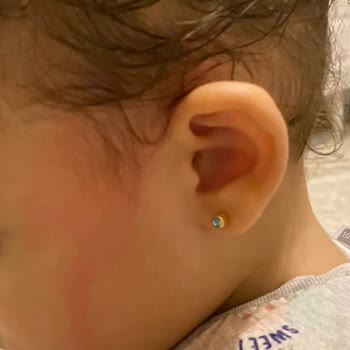 Dalin Saç Açıcı Sprey Cilt Reaksiyonu Yarattı