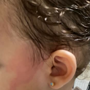 Dalin Saç Açıcı Sprey Cilt Reaksiyonu Yarattı