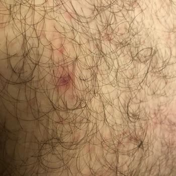 Alerjik Reaksiyon Ve Kaşıntı Kabusu: Persil Power Jel