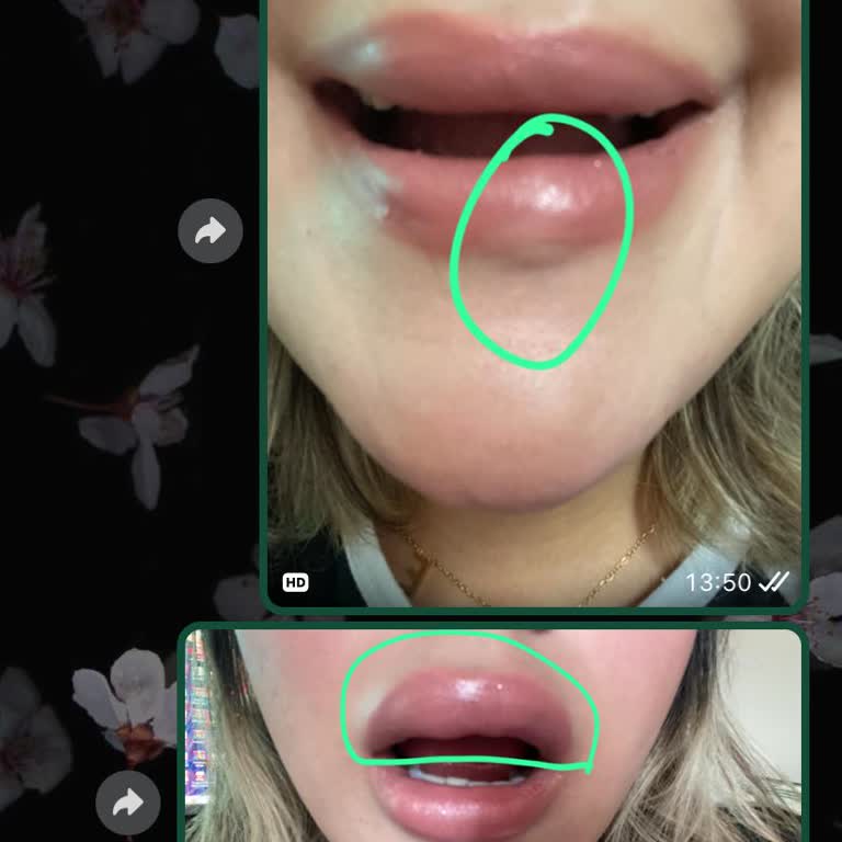 Dudak Dolgusu Ve İzin İhlali Kabusu