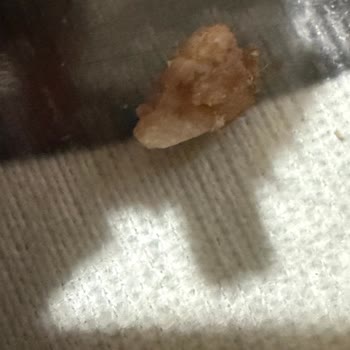 Domino's Siparişimde Kemik Çıktı Dişim Kırıldı