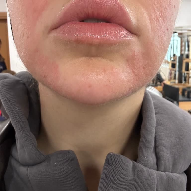 Abdi İbrahim Yanlış Tedavi Sonrası Yüzümde Kalıcı Hasar Endişesi