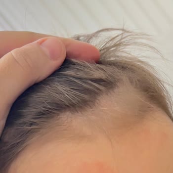 Bebeğimin Cildinde Döküntü Yapan Losyon