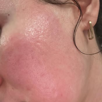 Isana Aktiv Kömür Maskesi Ciltte Yanma Ve Kızarıklık Yaptı