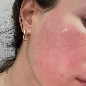 Isana Aktiv Kömür Maskesi Ciltte Yanma Ve Kızarıklık Yaptı