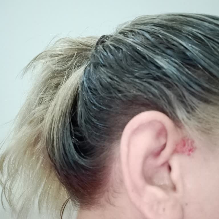 Yanlış Uygulama Sonrası Cilt Ve Saç Yanıkları