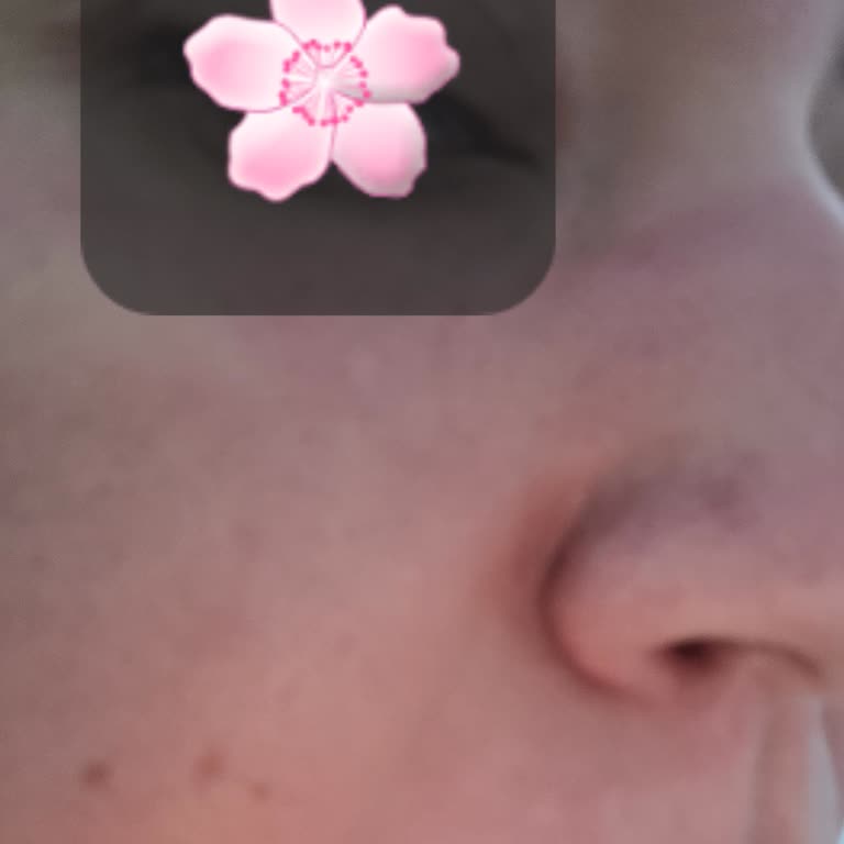 La Roche-Posay Effaclar Serum Burned My Face – Severe Irritation and Marks