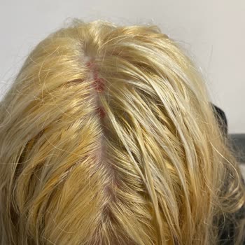 Palette Saç Boyası Kullanımında Ciddi Yanık Problemi