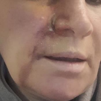 Lifting Sonrası Kâbus: İlgisizlik Ve Acı Dolu Deneyim