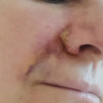 Lifting Sonrası Kâbus: İlgisizlik Ve Acı Dolu Deneyim