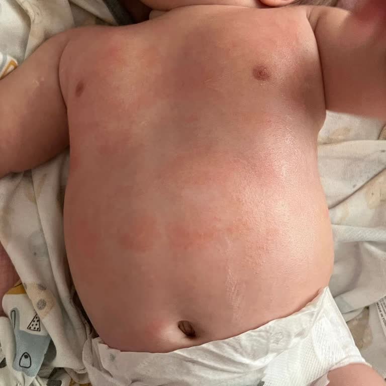 Bebek Kreminin Alerji Yapması Ve Hayal Kırıklığı