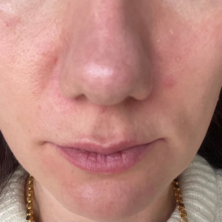 Flormar Ürünleri Cildimi Mahvetti!