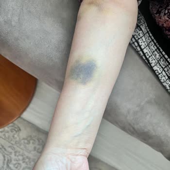 Koç Üniversitesi Acil Ameliyat Gerektiren Durumda Hastanede Yaşanan Sorunlar Ve Gereksiz Gecikmeler