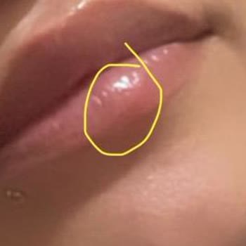 Bade Medikal Estetik Danışmanlığı Dudak Dolgusu Şikayeti