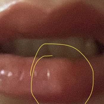 Bade Medikal Estetik Danışmanlığı Dudak Dolgusu Şikayeti