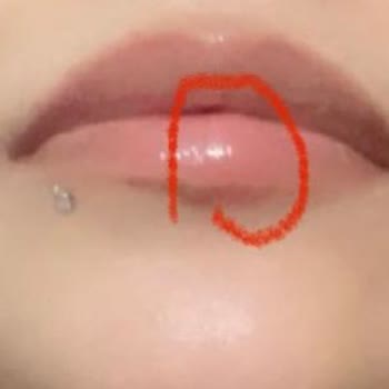 Bade Medikal Estetik Danışmanlığı Dudak Dolgusu Şikayeti