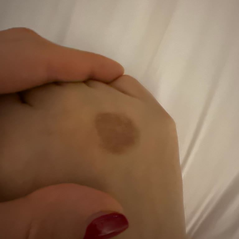 Gratis Ayak Maskesi Kullanımı Sonrası Yara Problemi