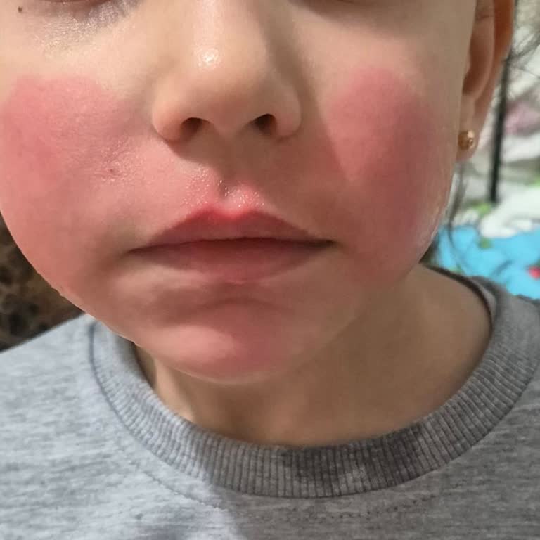 Krem Kullanımı Sonrası Yüzde Oluşan Sorun