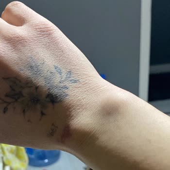 Ameliyatta Yapılmayan Kist Ve Süregelen Ağrılar