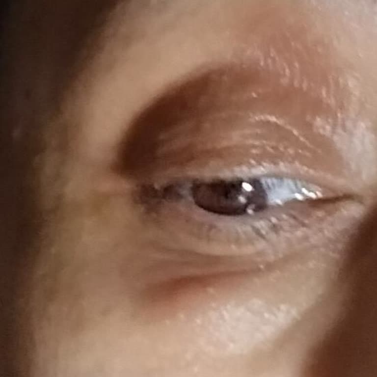 L'Oreal Ürünü Gözlerde Şişlik Ve Kaşıntıya Neden Oluyor