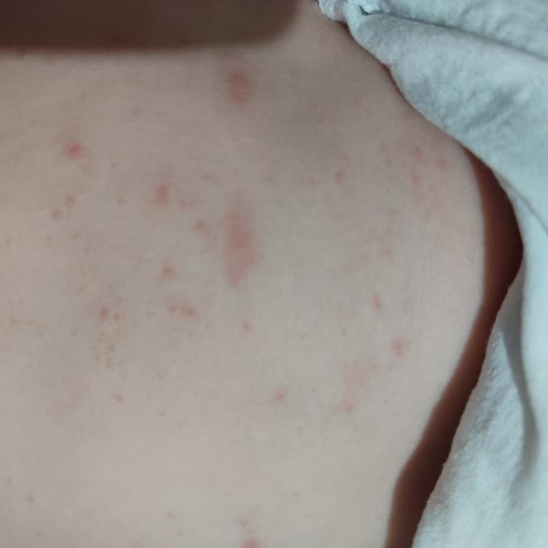 Mustela Krem Sonrası Bebeğimizde Kırmızı Benekler