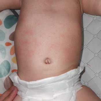 Mustela Krem Sonrası Kızarıklık Ve Ağlama Krizi