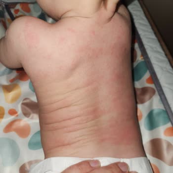 Mustela Krem Sonrası Kızarıklık Ve Ağlama Krizi