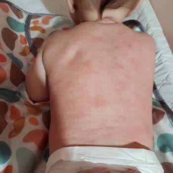 Mustela Krem Sonrası Kızarıklık Ve Ağlama Krizi
