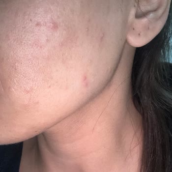 Celenes Termal Jel Krem: Sivilce Tarlasına Dönen Yüzüm