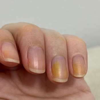 Flormar Ojesi Tırnaklarımda Kalıcı Leke Bıraktı