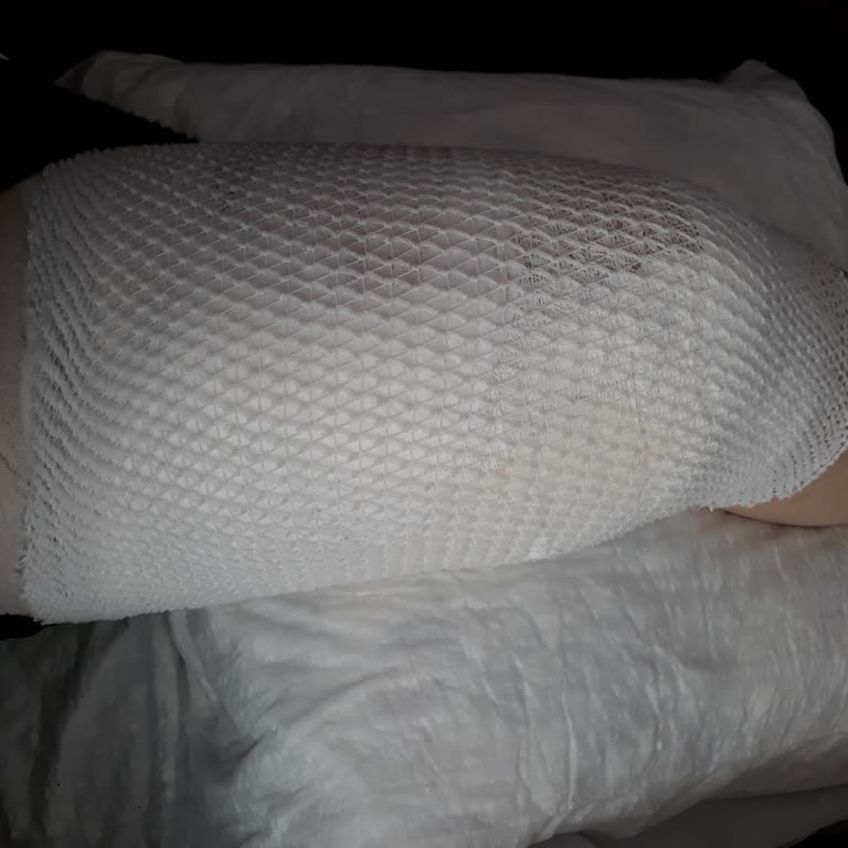 Yanlış Müdahale Sonucu Buz Yanığı