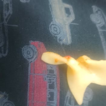 Makarnada Bulunan Yabancı Madde Şoku