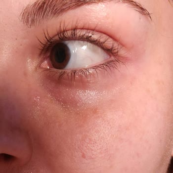 Estee Lauder Eye Concentrate Matrix 15 Ml Caused Severe Reaction and Skin Damage