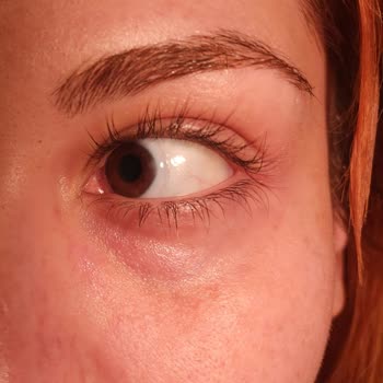 Estee Lauder Eye Concentrate Matrix 15 Ml Caused Severe Reaction and Skin Damage