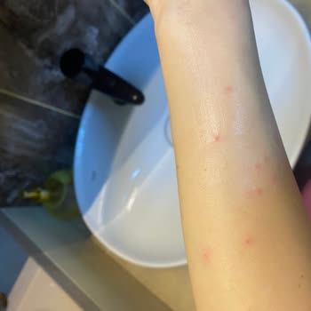 Vaseline Ürünü Ciltte Tahriş Ve Kızarıklık Yarattı