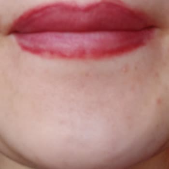 Eny Mila Yanlış Uygulama Sonucu Dudak Sorunları